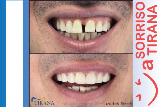 Dental tourism albania, reviews, price, packages, cost, albania dentist prices Cheap dental tourism albania
